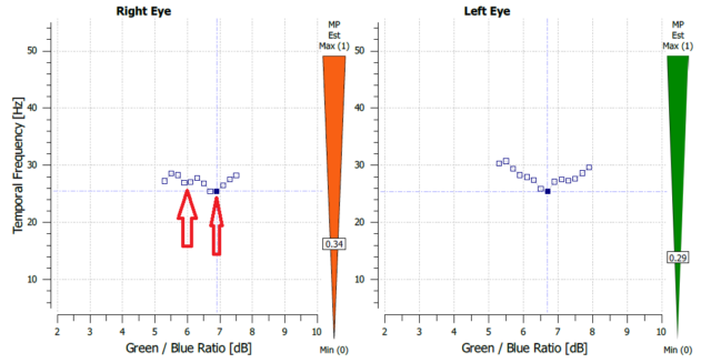 macular degeneration, dry amd, macular degeneration screening