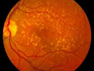 Dry vs Wet AMD: guide for patients