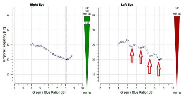 macular degeneration, dry amd, macular degeneration screening