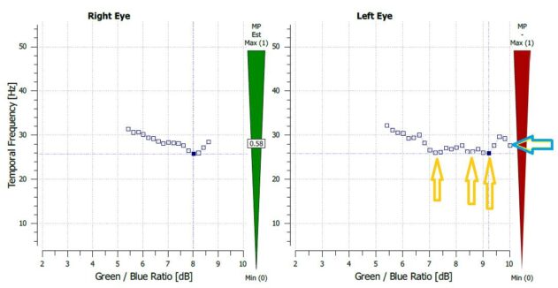 macular degeneration, dry amd, macular degeneration screening